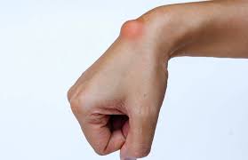 गैंग्लियन सिस्ट: कलाई की गांठ के दर्द को कम करने के लिए मोबिलाइजेशन तकनीकें