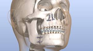 जबड़े की सर्जरी (Maxillofacial) के बाद मुंह खोलने (Mouth Opening) के सुरक्षित व्यायाम