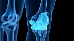 ज्वाइंट रिप्लेसमेंट के मरीजों के लिए घर पर सीढ़ियां चढ़ने और उतरने की सुरक्षित तकनीक