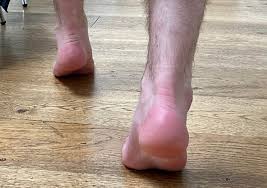 टॉडलर्स में 'टो-वॉकिंग' (पंजों पर चलना): क्या यह केवल एक आदत है या कोई न्यूरोलॉजिकल समस्या?