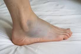 डांसर्स (क्लासिकल या गरबा) में टखने की मोच (Ankle Sprain) का बार-बार होना