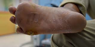 डायबिटिक फुट अल्सर (Diabetic Foot Ulcer) से बचाव: न्यूरोपैथी के मरीजों के लिए सही जूतों का चुनाव कैसे करें?