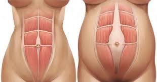 डिलीवरी के बाद पेट की लटकी मांसपेशियों (Diastasis Recti) को ठीक करने के व्यायाम