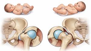 डिवेलपमेंटल डिस्प्लेजिया ऑफ हिप' (DDH): नवजात बच्चों में कूल्हे के जोड़ के खिसकने का फिजियो मैनेजमेंट