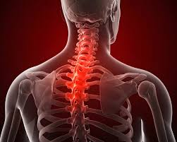 थोरैसिक आउटलेट सिंड्रोम (TOS): गर्दन से हाथ तक जाने वाले सुन्नपन और दर्द का इलाज