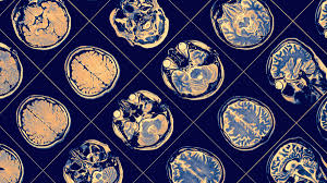 न्यूरोप्लास्टिसिटी (Neuroplasticity): लकवे (Stroke) के बाद दिमाग को फिर से कैसे ट्रेन करें?