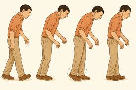 पार्किंसंस रोग में 'फ्रीजिंग ऑफ गेट' (चलते-चलते अचानक पैर रुक जाना) से निपटने के उपाय