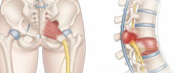 पिरिफोर्मिस सिंड्रोम: जांघ और कूल्हे के गहरे दर्द को सियाटिका से कैसे अलग पहचानें?