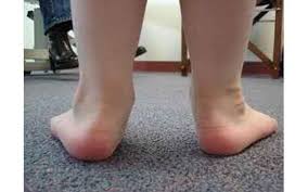 पीडियाट्रिक फ्लैट फुट: किस उम्र तक बच्चों के पैर सपाट होना सामान्य है और कब ऑर्थोटिक्स की जरूरत पड़ती है?