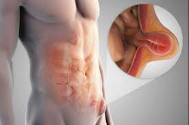 पेट की सर्जरी (जैसे हर्निया या अपेंडिक्स) के बाद कोर मसल्स को धीरे-धीरे कैसे मजबूत करें?