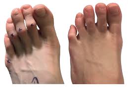 पैरों की उंगलियों का हथौड़े की तरह मुड़ जाना (Hammer Toes): कारण और इसे सीधा करने की स्ट्रेचिंग