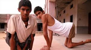 पोस्ट-पोलियो सिंड्रोम (Post-Polio Syndrome): बढ़ती उम्र के साथ मांसपेशियों की कमजोरी का प्रबंधन