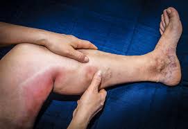 पोस्ट-सर्जिकल डीवीटी (Deep Vein Thrombosis) से बचने के लिए एंकल पंप्स (Ankle Pumps) का महत्व