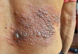 पोस्ट-हर्पेटिक न्यूराल्जिया: दाद (Shingles) के बाद नसों के तेज दर्द को शांत करने की फिजियोथेरेपी
