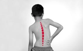बच्चों की रीढ़ की हड्डी में टेढ़ापन (Idiopathic Scoliosis) की शुरुआत में पहचान कैसे करें?