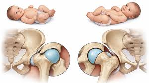 बच्चों में जन्मजात हिप डिसलोकेशन (DDH): कूल्हे के खिसकने का शुरुआती इलाज