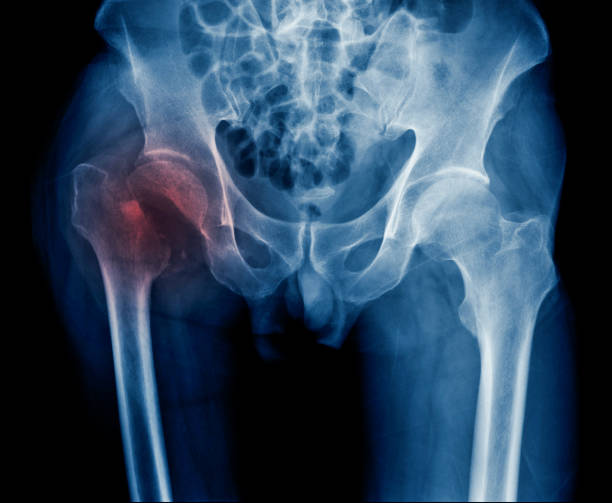 बारिश के मौसम में फिसलन भरी सड़कों पर गिरने से होने वाले हिप फ्रैक्चर (Hip Fracture) से बुजुर्गों का बचाव