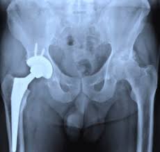 बुढ़ापे में कूल्हे की हड्डी टूटने (Hip Fracture) से पहले हड्डियों को 'फॉल-प्रूफ' (Fall-Proof) कैसे बनाएं?