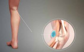 बेकर्स सिस्ट: घुटने के पीछे सूजन और गांठ का फिजियोथेरेपी मैनेजमेंट