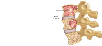 मल्टीपल माइलोमा (हड्डी का कैंसर) के मरीजों के लिए दर्द प्रबंधन और पैलिएटिव (Palliative) केयर