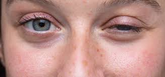 मायस्थेनिया ग्रेविस (Myasthenia Gravis): अत्यधिक थकान को मैनेज करने के लिए पेसिंग तकनीकें