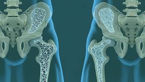 मेनोपॉज (रजोनिवृत्ति) के दौरान हड्डियों के कमजोर होने (Osteoporosis) से बचाव के उपाय