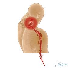 रेडिकुलोपैथी (Radiculopathy): जब गर्दन का दर्द आपके अंगूठे और उंगलियों तक करंट की तरह दौड़े