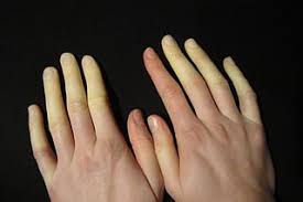 रेनॉड सिंड्रोम (Raynaud's): सर्दियों में उंगलियों के सुन्न होने और नीले पड़ने से कैसे रोकें?