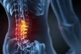 लंबर कैनाल स्टेनोसिस: थोड़ी दूर चलते ही पैरों में भारीपन और दर्द (Neurogenic Claudication)