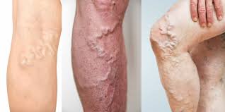 लगातार बैठे रहने से डीवीटी (DVT - Deep Vein Thrombosis) का खतरा और लेग पंपिंग एक्सरसाइज