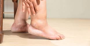 लिम्फेडेमा (Lymphedema) मैनेजमेंट: सूजन वाले अंगों में कॉम्प्रेशन बैंडेज बांधने का सही तरीका