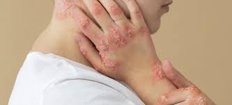 ल्यूपस (SLE) के मरीजों में जोड़ों का दर्द और थकान दूर करने के हल्के व्यायाम