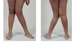 'वल्गस नी' (Knock Knees) और 'वारस नी' (Bow Legs): घुटनों के शेप का आपके टखने (Ankle) पर क्या प्रभाव पड़ता है?