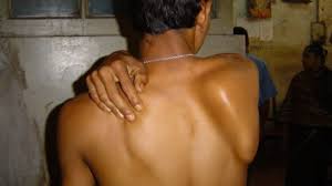 'विंगिंग ऑफ स्कैपुला' (Winging of Scapula): कंधे की हड्डी का पीछे की तरफ बाहर निकलना और इसे ठीक करने के व्यायाम