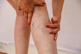 वेरिकोज वेन्स (Varicose Veins) के मरीजों को पैरों में खून का बहाव सुधारने के लिए कौन से व्यायाम करने चाहिए?