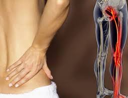 शियाटिका (Sciatica) का दर्द ज्यादातर सिर्फ एक ही पैर में क्यों जाता है? एनाटॉमी और बायोमैकेनिक्स की सच्चाई