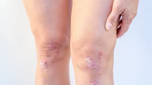 सोरायटिक अर्थराइटिस: त्वचा की समस्या के साथ-साथ जोड़ों के दर्द से कैसे निपटें?