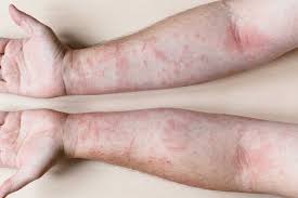 सोरियाटिक अर्थराइटिस: त्वचा रोग के साथ जोड़ों के दर्द का फिजियोथेरेपी मैनेजमेंट