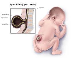 स्पाइना बिफिडा (Spina Bifida) के साथ जन्मे बच्चों का मोटर विकास और रिहैब