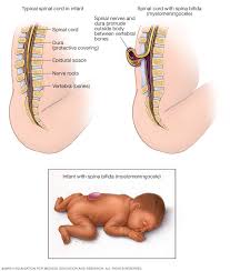 स्पाइना बिफिडा ओकल्टा (Spina Bifida Occulta): लोअर बैक में बालों का गुच्छा और छुपा हुआ रीढ़ का डिफेक्ट