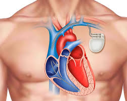 हार्ट में पेसमेकर (Pacemaker) वाले मरीजों के लिए कौन सी फिजियोथेरेपी मशीनें (जैसे TENS/SWD) सख्त मना हैं?