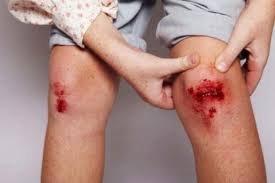 हीमोफीलिया के मरीजों के लिए जोड़ों से खून बहने (Bleeding in Joints) के बाद फिजियोथेरेपी