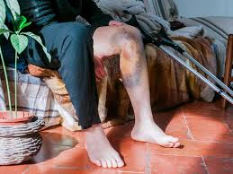 हीमोफीलिया में जोड़ों के अंदर खून बहने (Hemarthrosis) के बाद सुरक्षित फिजियोथेरेपी