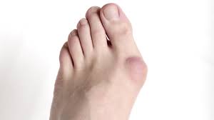 हैलक्स वाल्गस (Hallux Valgus_Bunions) अंगूठे की हड्डी बाहर निकलने से रोकने के टो-सेपरेटर उपाय