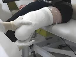 3डी प्रिंटिंग (3D Printing) फिजियोथेरेपी में भारी प्लास्टर की जगह हल्के और हवादार 3डी प्रिंटेड स्प्लिंट्स (Splints) का उपयोग।
