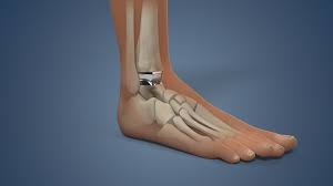 एंकल रिप्लेसमेंट (Ankle Arthroplasty): घुटने से अलग, टखने की सर्जरी के बाद चलने की प्रक्रिया कैसे होती है?