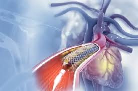 एंजियोप्लास्टी (Stent Placement) के कितने दिन बाद सीढ़ियां चढ़ना और वजन उठाना सुरक्षित है?
