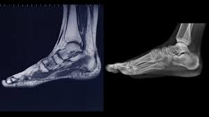 एक्स-रे (X-Ray) बनाम एमआरआई (MRI): फिजियोथेरेपिस्ट किस रिपोर्ट को देखकर आपके दर्द का असली कारण तय करते हैं?