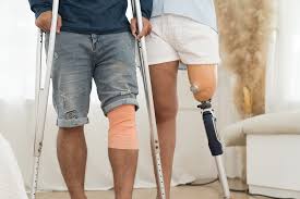 एम्प्यूटेशन (कटे हुए अंग) अंग कटने के बाद बचे हुए हिस्से (Stump) की देखभाल और सही बैंडेजिंग।