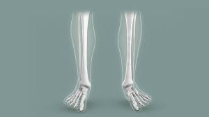 ओवरप्रोनेशन (Overpronation): चलते समय पैरों का अंदर की तरफ गिरना और इसके कारण घुटने का घिसना